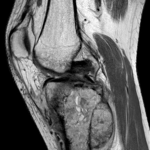 Osteosarcoma Proximal Tibial MRI0002